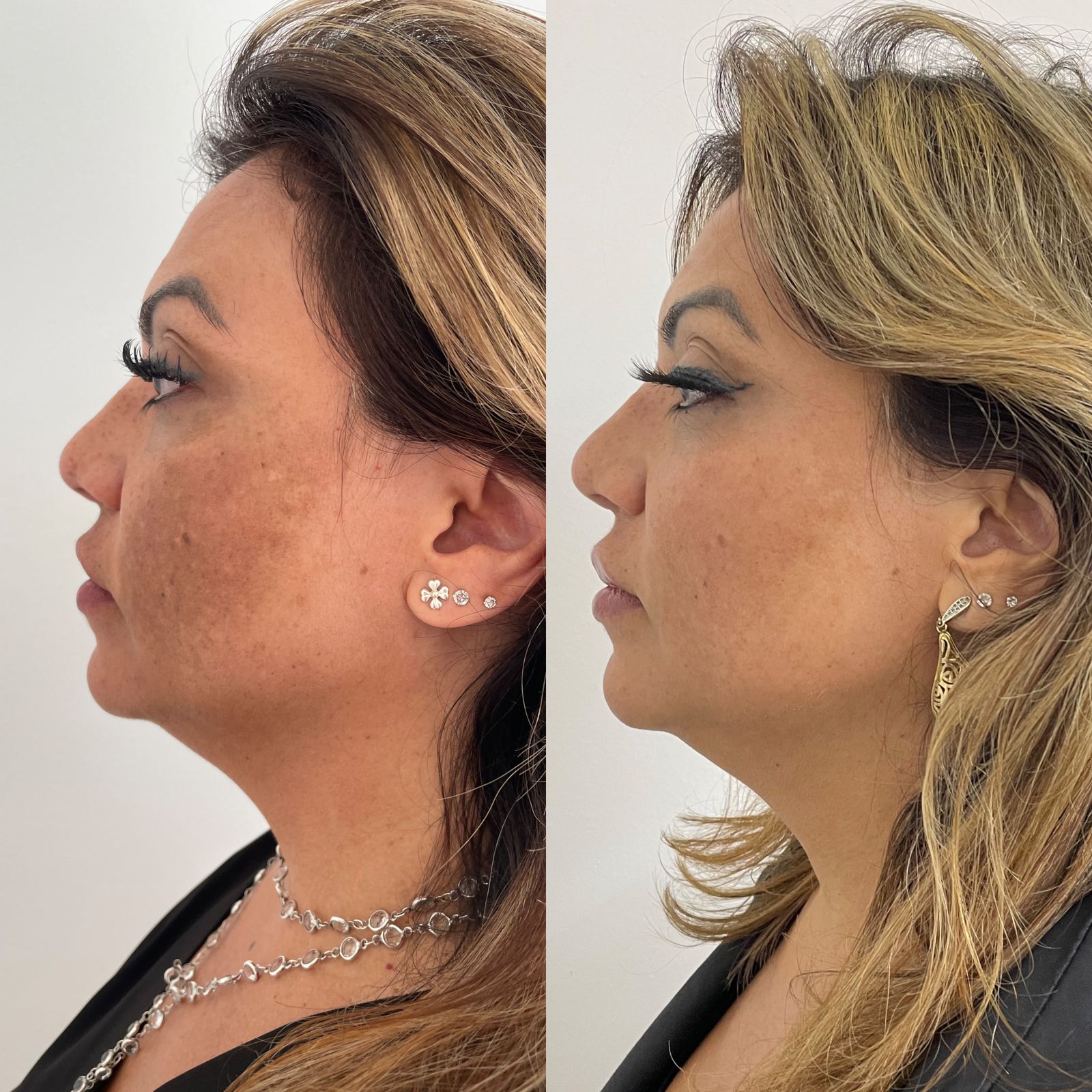 melasma